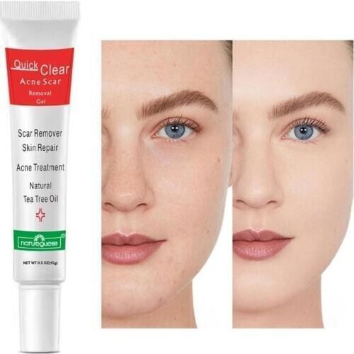 15g Acne Treatment Face Cream Remover Scar Blackhead Oil Control Repair Shrink Pores Whitening Skin Care Gel Korean Cosmetics