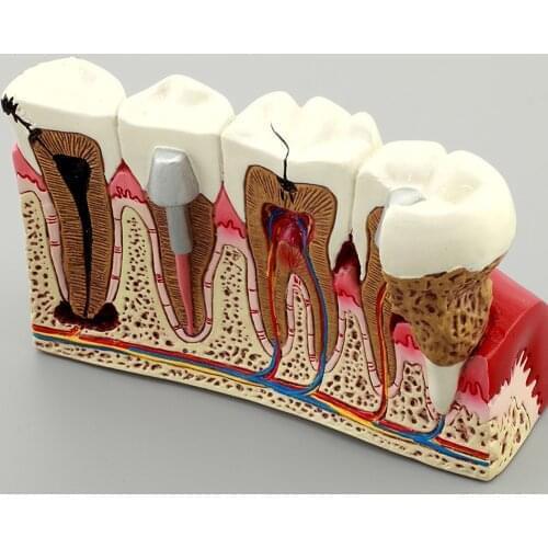 Dental Pathologies Caries Teeth Model M4029/Dental Pathologies Education Teeth Model Dental Root Canal Tooth Model
