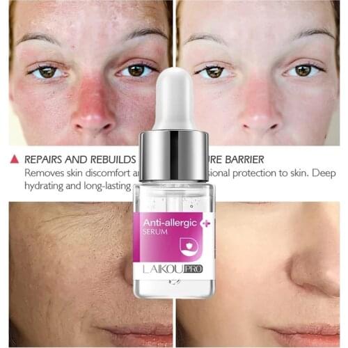 Anti-Allergy Serum Moisturizing Anti-Redness Deep Hydration Soothy And Repair Damaged Skin facial Care Cosmetics