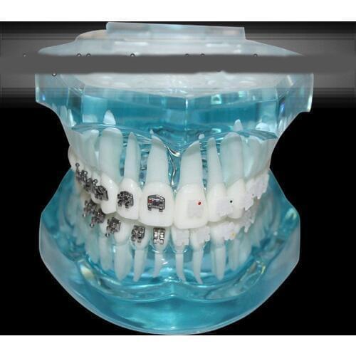Dental Orthodontic model self-ligating bracket straight wire edgewise bracket four kinds of ceramic brackets comparison model
