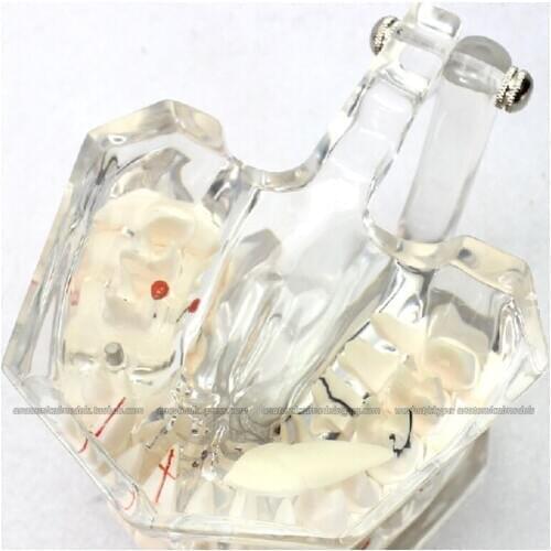 CMAM/12594 Dental- Pathological dental model, 2X life size,Human Oral Dental Medical Teaching Anatomical Model