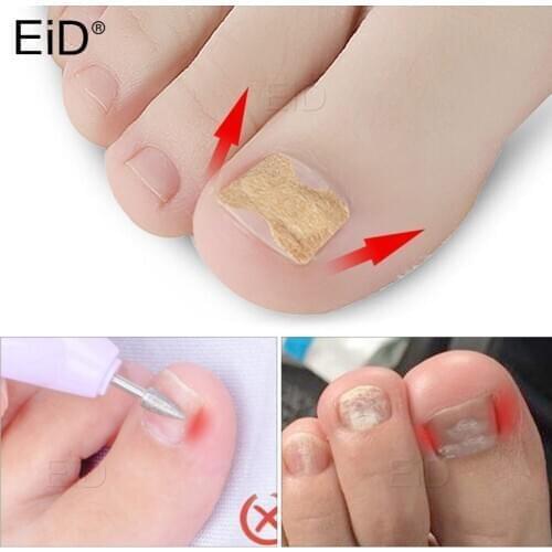 EiD 1Set Ingrown Toenail Corrector Sticker Paronychia Treatment Corrector Pedicure Foot Orthodontic Toe Thumb Nail Care Patches