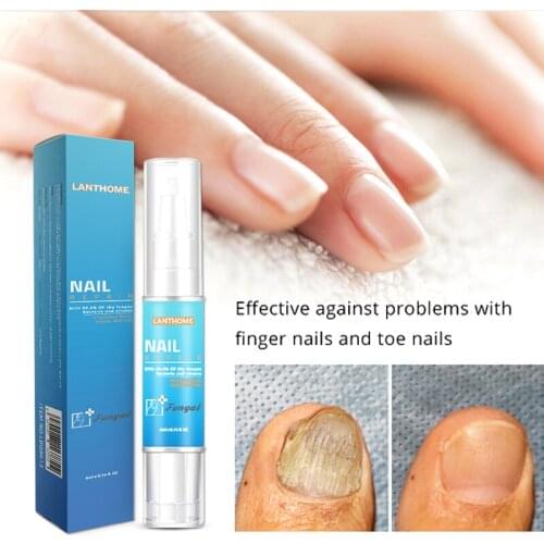 Powerful Fungal Nail Treatment Pen Onychomycosis Paronychia Anti Fungal Nail Herbal Medicinal Liquid Repair Pen Hand Feet Care