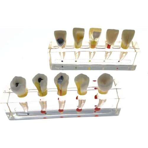 Dental Teeth Model Endodontic Treatment Model Root canal treatment model Teaching research model for dentistry students