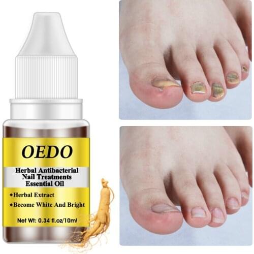 Antibacterial Nail Treatment Essential Oil Herbal Extract Nail Fungus Repair Tools Toenail Care