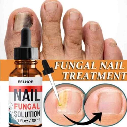 Nail Repair Serum Essences Fungal Treatments Treatment Serum Foot Nail Fungus Removal Anti-infective Paronychia Onychomycosis