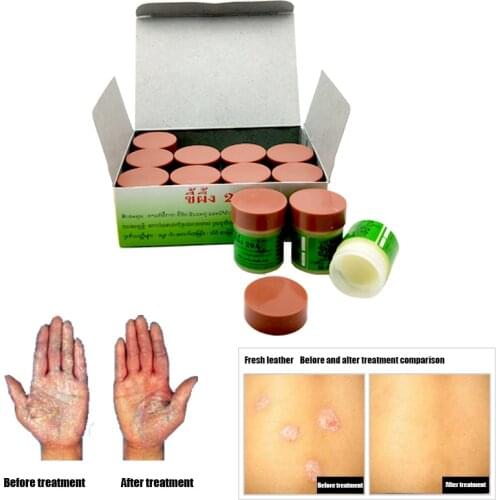 1PCS Thailand 29A Ointment Treatment Psoriasis Eczma Dermatitis Urticaria Cream Natural Skin Care