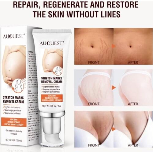 Pregnancy scar removal acne cream anti-aging anti-wrinkle firming body cream stretch mark treatment maternal repair 45g
