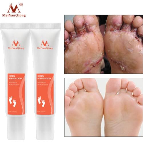 2PCS Herbal Foot Treatment Anti Fungal Infection Onychomycosis Paronychia Toe Fungus Treatment Removal Dead Skin Hand Feet Care