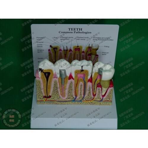 Teeth Common Pathologies Model