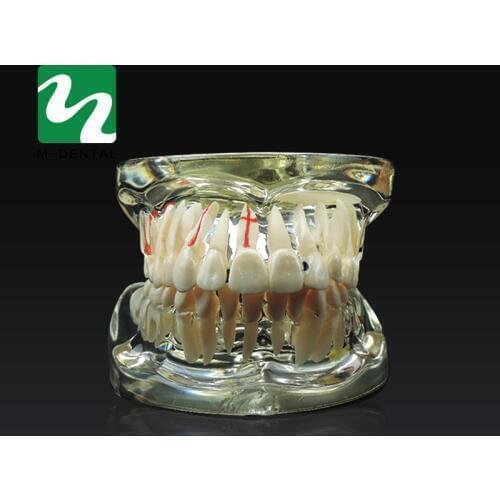 Dental Study Tooth Model Adult Pathological& Disease Teaching Teeth Model Removable For Free Shipping