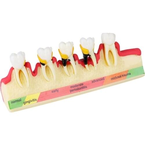 Doctor-patient communication teeth model/Oral Teeth Model Periodontal Disease Model /Dental disease tooth model M4010