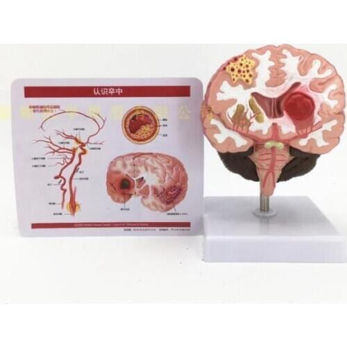 Human brain anatomy brain pathological disease brain pathological structure cerebral vascular disease brain model