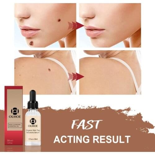 Organic Tags Remove Serum Mole Corrector Skin Tag Remover Black Spot Purifying Serum Skin Lightening Mole TAG Removal Essences