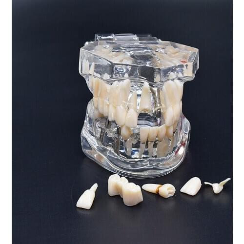 Dental Implant Disease Teeth Model 1pcs With Restoration Bridge Tooth Dentist For Medical Science Dental Disease Teaching Study