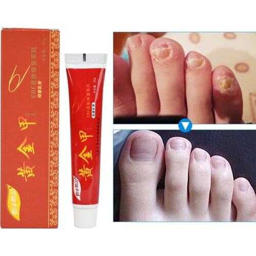 Chinese Medicine Plaster Nail Treatment Cream Onychomycosis Anti Fungal Nail Infection Fights Bacteria Naturally ointment