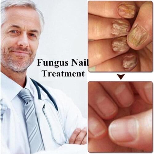 Onychomycosis Nail Repair Solution Liquit Fungal Nails Treatment Hand Fast Fingernail Sterilization Care For Foot Non-irrit W1U7