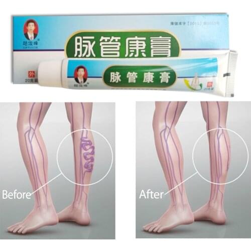 MQ 2 Boxs Varicose Veins Treatment Cream Chinese Patch Anti Foot Leg Vasculitis Phlebitis Herbal Product Medical Plaster