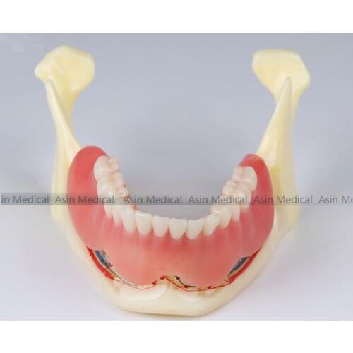 Dental high quality new Resin mandibular denture Coverage model Mandible belt nerve model Display dentures Removable teeth model