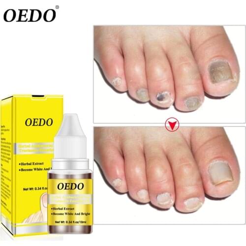 OEDO Fungal Nail Repair Essence Toe Nail Fungus Treatment Serum Nails Gel Paronychia Onychomycosis Anti Infection Nail Care 10ml