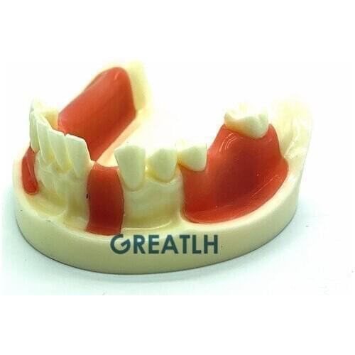 Dental Lower Jaw Gingiva Implant Practice model missing teeth dentist educational student study teeth practise model
