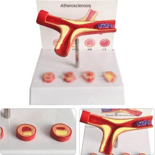 Vascular blockage model Blood concentration fat pathology blood vascular porridge-like vascular pathology anatomy