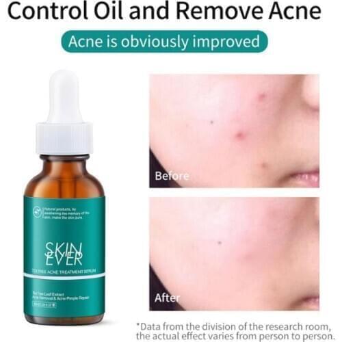 30ML NEW Tea Tree Extract Serum Repair Skin Oil Control Acne Removal Pimple Serum Shrink Pores Moisturizing Anti-wrinkle TSLM2