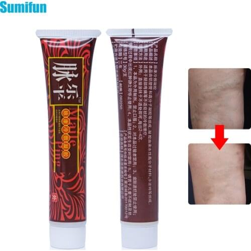1Pcs Varicose Veins Treatment Cream Ointment Vasculitis Phlebitis Spider Pain Relief Varicosity Angiitis Herbal Medical Plaster