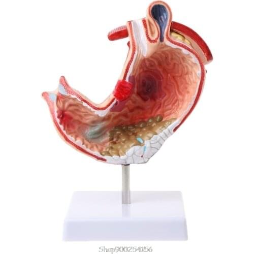 Human Anatomical Anatomy Stomach Model Gastric Pathology Gastritis Ulcer Teaching Learning Tool N11 20 Dropship