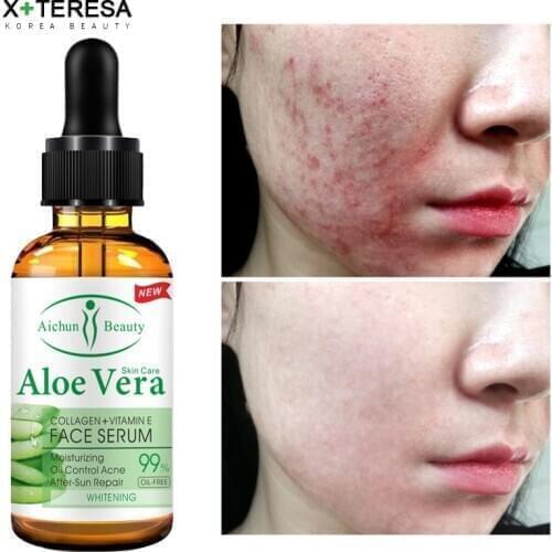 Acne Treatment Serum Aloe Vera Anti Acne Pimple Scar Removal Natural Essence 100% Effective After Sun Repair Moisturizing Serum