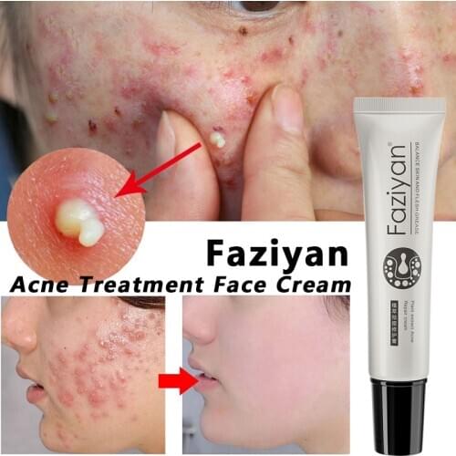 Acne Treatment Face Cream Blackhead Repair Oil Control Shrink Pores Scar Moisturizer Skin Care Korean Cosmetics Whitening Creams