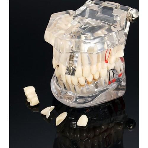 1 Pcs Dental Model Teeth Implant Restoration Bridge Teaching Study Tooth Medical Science Disease Dentist Dentistry Products