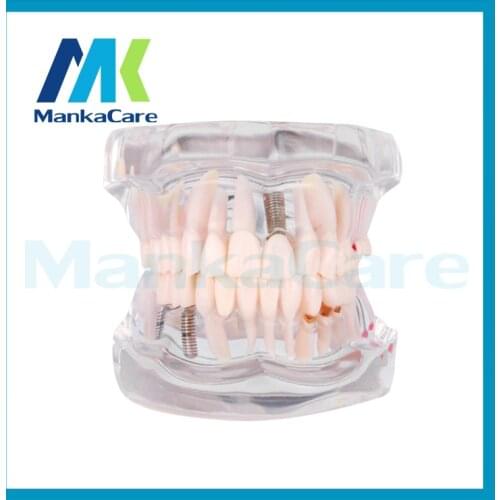 Manka Care - Removable Dental Implant Disease Teeth Model with Restoration Bridge Tooth Dentist for Medical Science Teaching