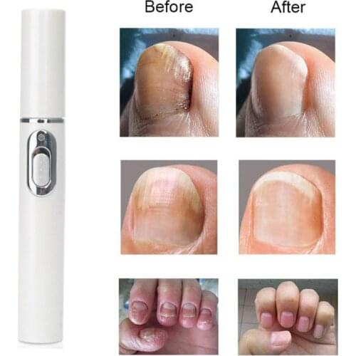 Nail Repair Laser Pen Painless Anti-fungal Kill Onychomycosis Be Used With Repair Fluid Serum For Foot Nails Care Manicure Tools