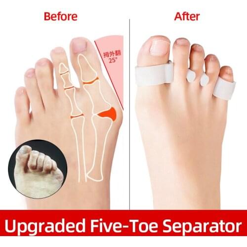 2 Pcs Toe Separator Upgraded Overlapping Toe Corrector Hallux Valgus Bunion Corrector Feet Bone Straightener Adjuster Foot Care