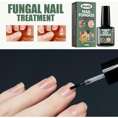 Nail Fungal Treatment Feet Care Repair Treatment Fungal Nail Antifungal Fungus Nail Care Paronychia Onychomycosis TSLM1
