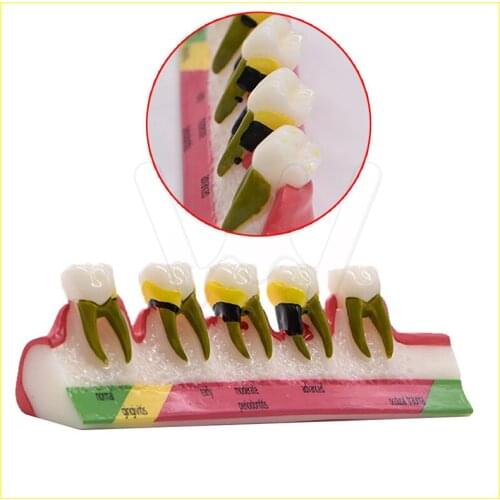 Dental Caries Demonstration Model Teeth Teaching Periodontal Disease Assort Tooth Typodont Model