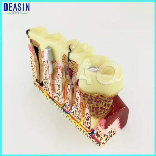 High Quality Caries Tooth Model Dentist Patient Communication Anatomy Model Dentistry Rich Details Teaching Aids Equipment