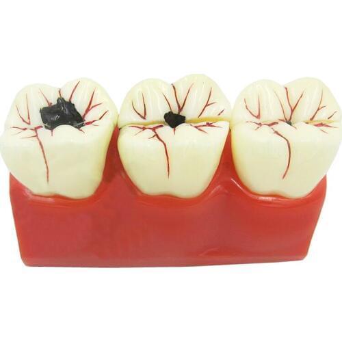 1PC 4 times Denture Disease Teeth Model Caries Decomposition Decay Tooth Model For Dental Medical Demo Teaching