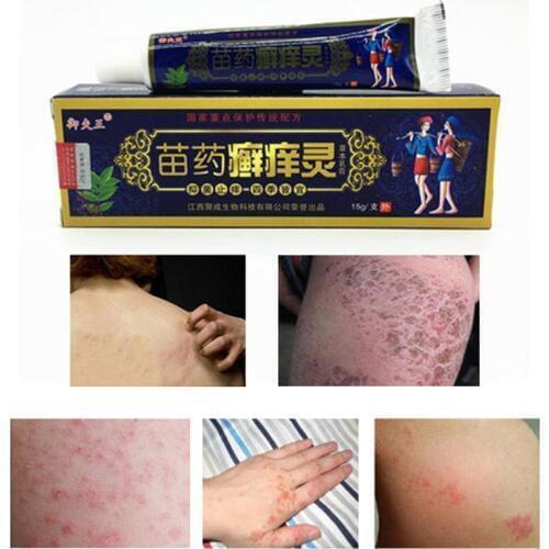 Natural Skin Care Antipruritic Body Psoriasis Cream Dermatitis Eczema Pruritus Psoriasi With Retail Box Beauty Body Skin Care