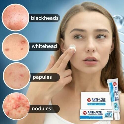 Boy Girl Student Anti Acne Scar Removal Face Treatment Repair Skin Care Cream