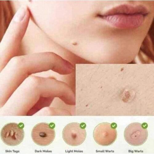 Genital External Wart Corn Remover 3ml Treatment Papillomas Removing Warts Removal Moles