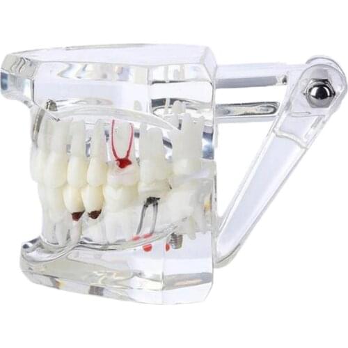 1pc Transparent Study Teeth Model with Nerve Repair Demonstration