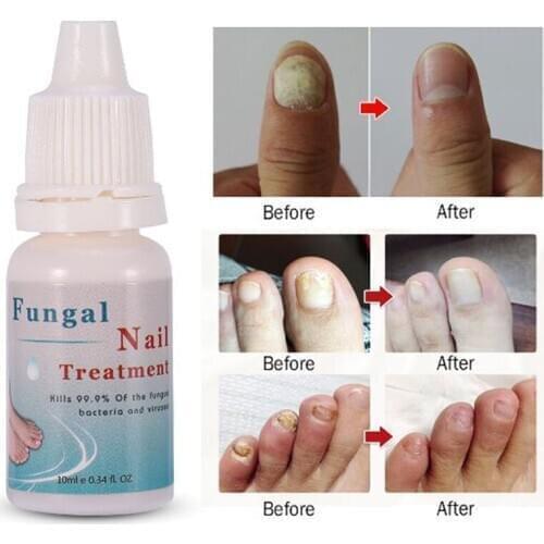 10ML Fungal Nail Repair Essence Serum Care Treatment Foot Nail Fungus Removal Gel Anti Infection Paronychia Nail Skin Care TXTB1