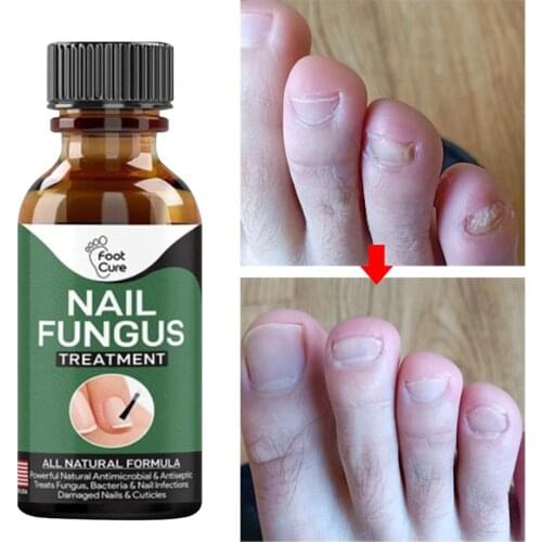 Fast Nail Fungal Treatments Nail Repair Essences Serum Care Toe Foot Nail Fungus Removal Gel Paronychia Onychomycosis 10/20/30ml
