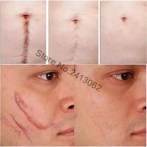 Natural Authentic Anti Acne Spots Face Anti Care Acne Treatment Scar Removal Oily Skin Acne Spots Skin Care Face Stretch Marks