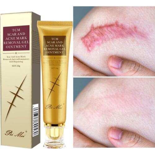 Acne Scar Removal Cream Gel Face Pimples Stretch Marks Cream Repairing Smoothing Whitening Moisturizing Body Cream Skin Care 30g