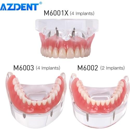 AZDENT Dental Implant Teeth Model Removable Interior Mandibular Demo Overdenture With Implants Upper Lower Tooth Teaching Study
