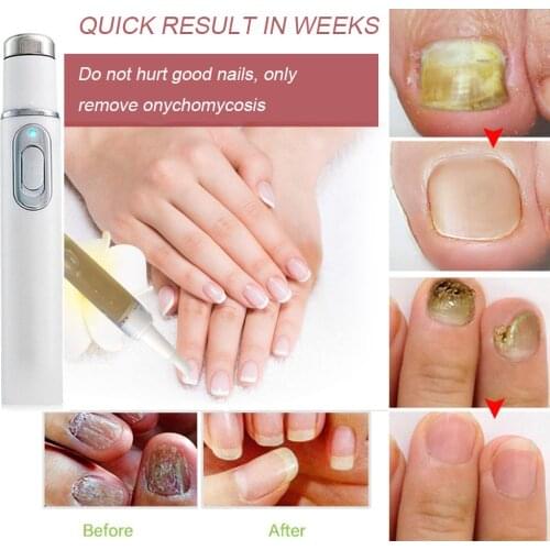 2PCS/Set Nail Repair Liquid Pen Laser Pointer Painless Powerful Effective Anti-fungal Removal Onychomycosis Bacteriostatic Care