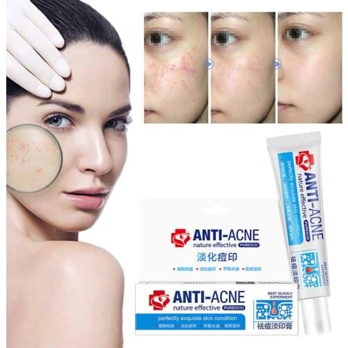 New 30g Chinese Medicine Acne Cream Safe&Gentle Remove Acne Oil Control Shrink Pores Gel Face Care Cream TSLM1